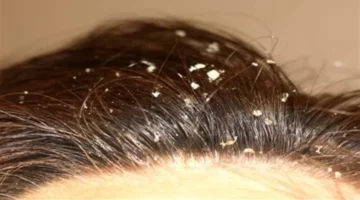 أنواع قشرة الرأس: التعرف على الأسباب المختلفة لكل نوع وطرق العلاج الفعّالة